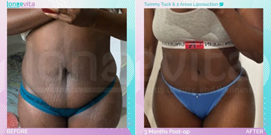 Liposuction and Tummy Tuck before and after, Body, 30s female patient