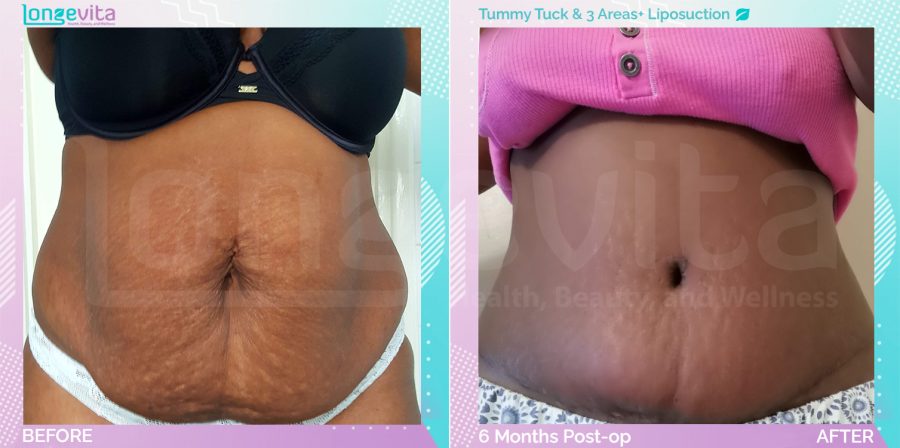 Liposuction and Tummy Tuck before and after, Body