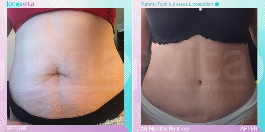 Liposuction and Tummy Tuck before and after, Body, 30s female patient