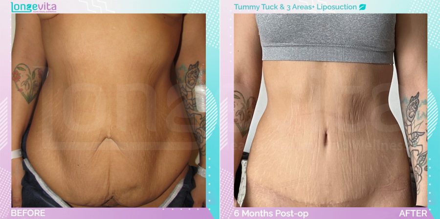 Liposuction and Tummy Tuck before and after, Body, 20s female patient