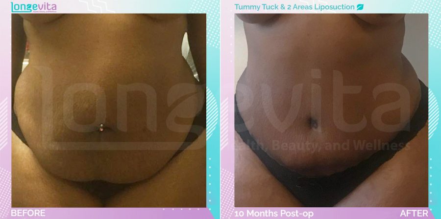 Liposuction and Tummy Tuck before and after, Body