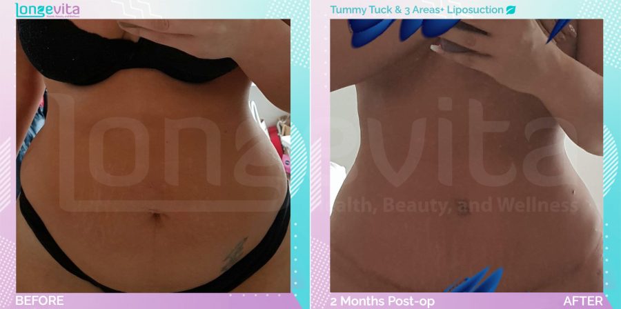 Liposuction and Tummy Tuck before and after, Body