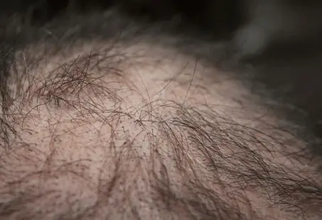 biofibre hair transplant