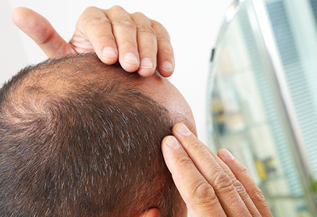 male pattern hair loss