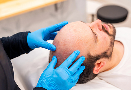 mega session hair transplant
