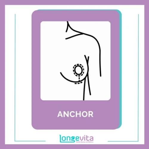 Anchor Breast Implant Incision