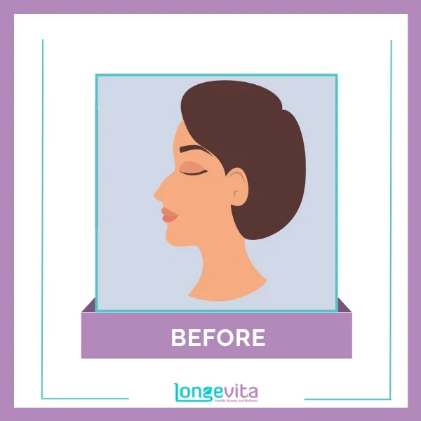 Non surgical nose job before